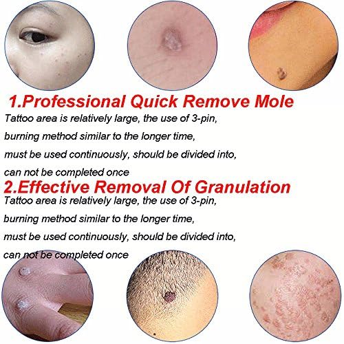 UNIQKART Lcd Tattoo Mole Removal Plasma Pen Laser Facial Freckle Dark Spot Remover Tool Wart Removal Machine Face Skin Care Beauty Device