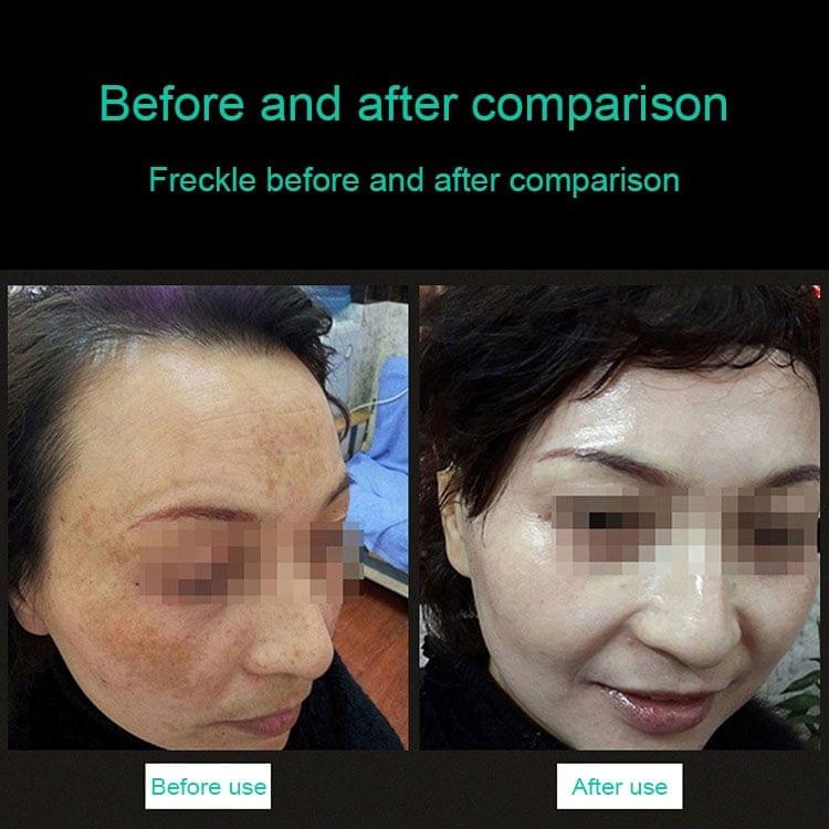 Handheld Picosecond Portable (Removing Tattoo Freckle Mole Dot) Machine Laser Plasma Beauty Care Pen, EU Plug(Blue Light)