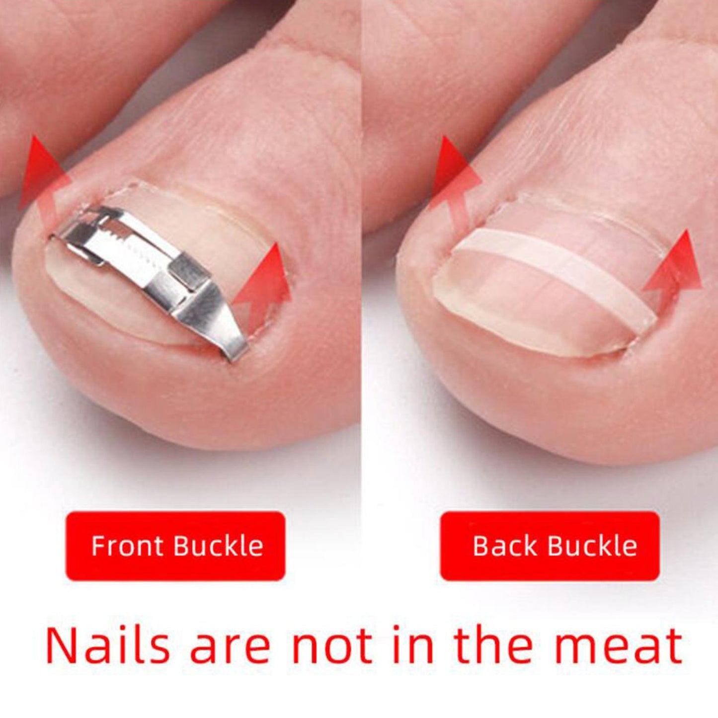 Ingrown Toenail Treatment Ingrowing Corrector Pedicure Tool Foot Care Set C