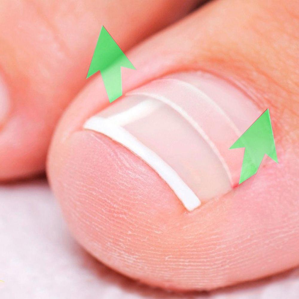 Ingrown Toenail Correction Set Toenail Treatment Toenail - 01(12pcs)