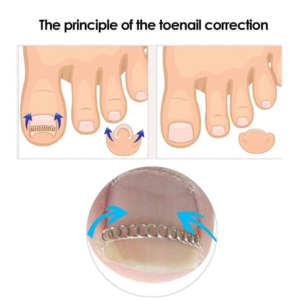 Anself 6Pcs/Box Ingrown Toenail Correction Wire Fixer