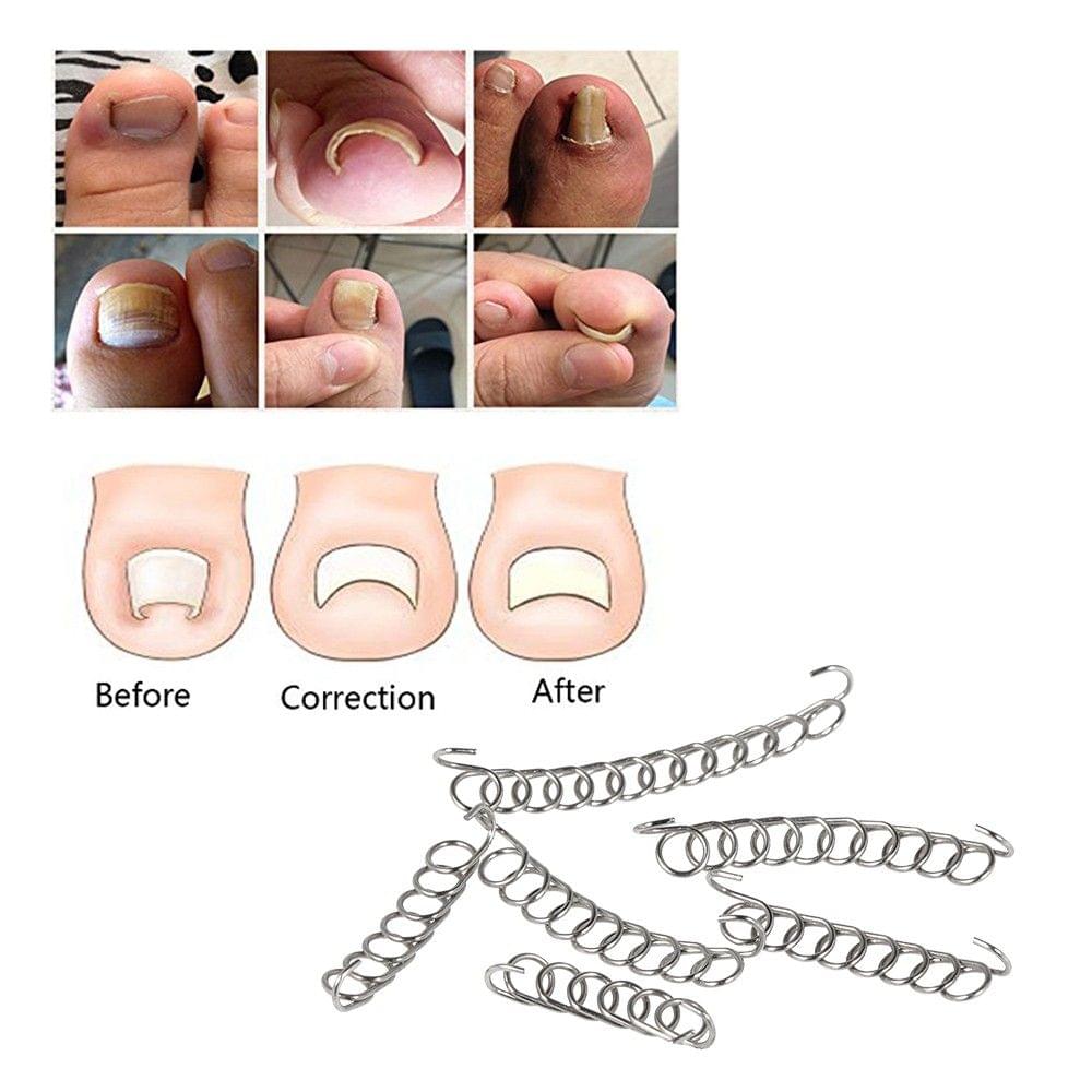 Anself 6Pcs/Box Ingrown Toenail Correction Wire Fixer