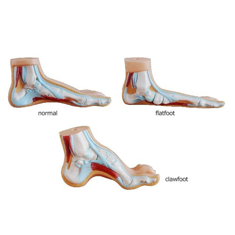 1 Pair Flat Feet Orthotic Plantar Fasciitis Arch Support Sleeve Cushion Pad Heel Spu Foot Care Insoles foot Pad Orthotic Tool