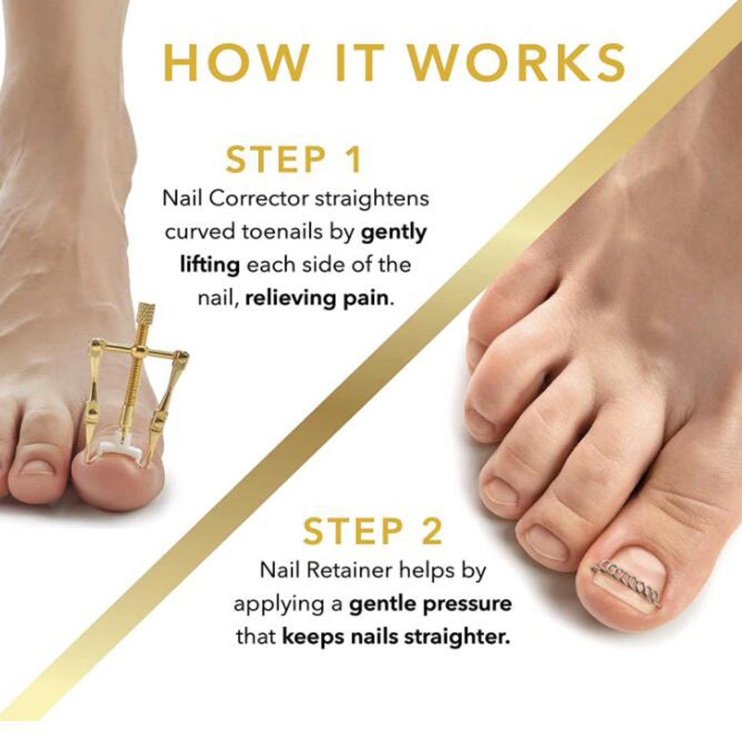 Ingrown Toenail Correction Nail Lifter Clamp File Toe Treatment Tool kit
