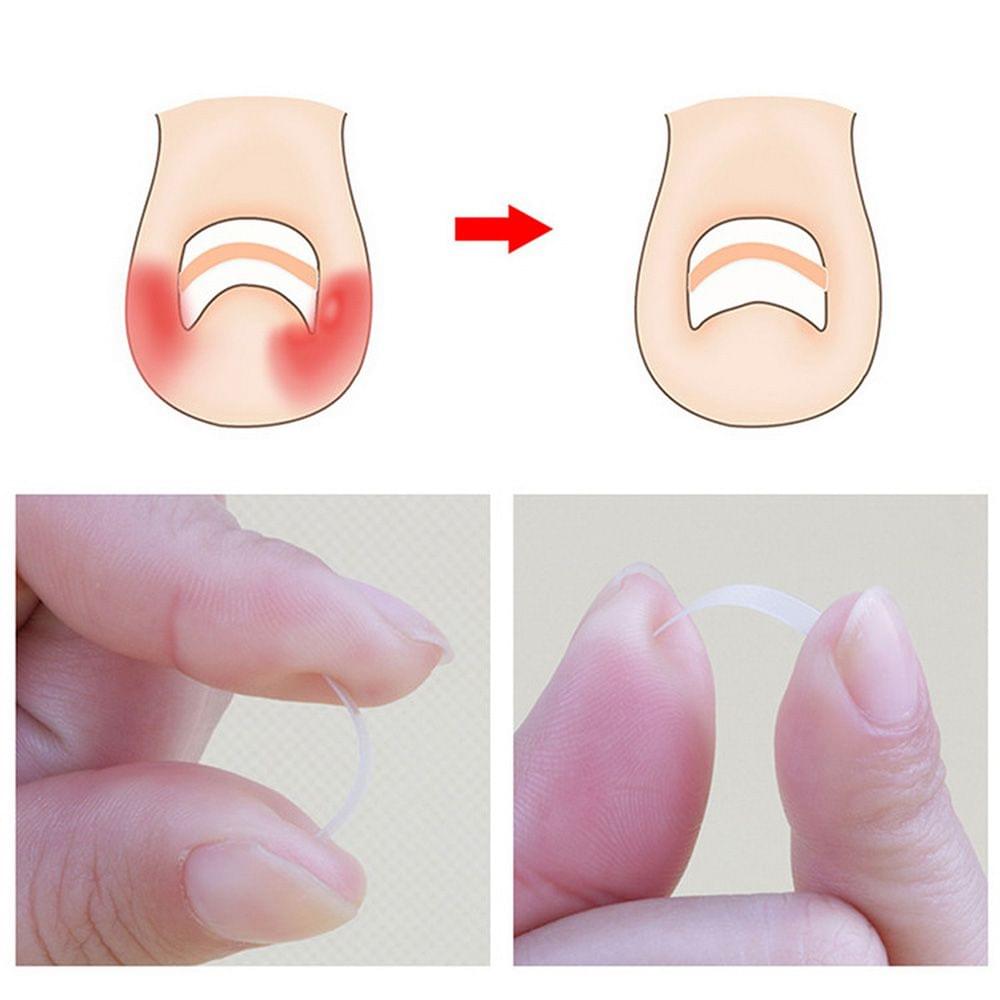 Ingrown Toenail Correction Set Toenail Treatment Toenail - 01(12pcs)