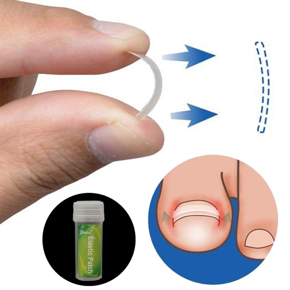Ingrown Toenail Correction Set Toenail Treatment Toenail - 01(12pcs)