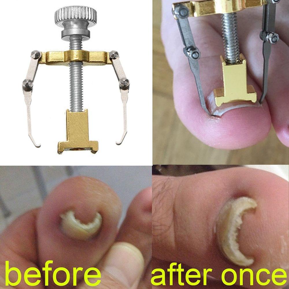 Ingrown Toenail Correction Set Toenail Treatment Toenail - 01(12pcs)
